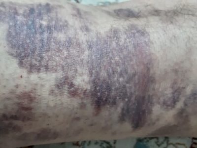 آسیب دیدگی کارشناس شبکه دامپزشکی شهرستان برخوار از ناحیه پا در اثر حمله گاو